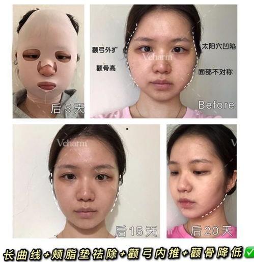 颧骨内推视频,重塑面部轮廓的神奇之旅